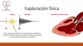Insuficiencia aórtica