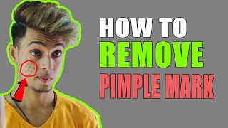 Remove Pimple Marks In Just 1Week ? HINDI ? SAYAN