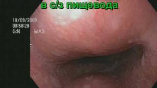 Подслизистое образование пищевода.