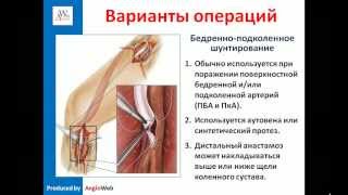 Атеросклероз сосудов нижних конечностей лечение