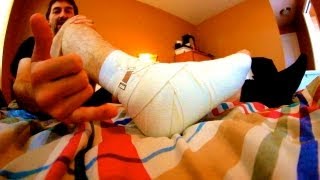 HOW TO HEAL A SPRAINED ANKLE THE EASIEST WAY TUTORIAL
