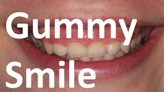 Orthotropics Treatment of Gummy Smile (Excessive Gingival Display) by Prof John Mew