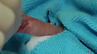 الطهارة الحديثة باستخدام الحلقة البلاستيكية plastibell circumcision