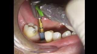 How to place a Dental Implant in 5 minutes.