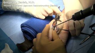 Thumb Radial Collateral Ligament Reconstruction at MPJ