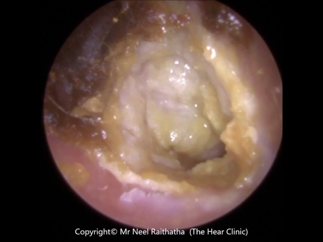 194: Eardrum about to 'EXPLODE' after Blocked Ear Wax Removal using